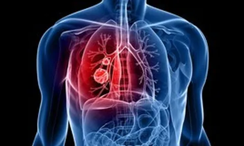 Không hút thuốc vẫn mắc ung thư phổi: Bác sĩ Bạch Mai chỉ ra những nguyên nhân ít người biết