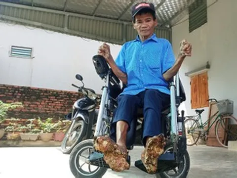 Cuộc sống của người đàn ông mắc bệnh 'người cây' hiếm gặp ở Ninh Bình