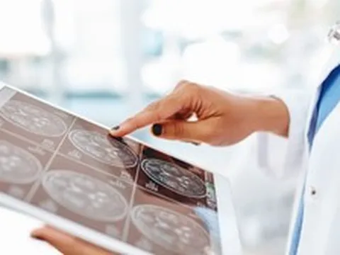 Đột quỵ do xuất huyết não đang gia tăng ở người trẻ: Đây là "thủ phạm" hàng đầu