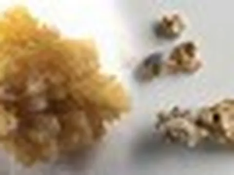Vì sao sỏi thận có viên tròn nhẵn, viên lại sắc nhọn như san hô?
